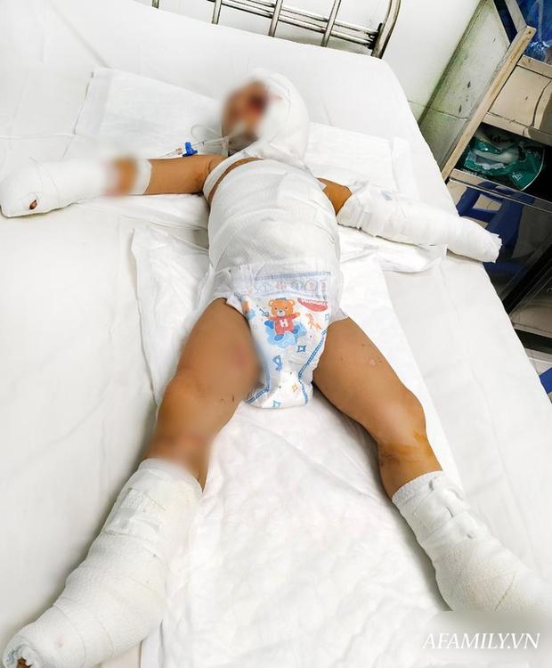 Hai bé trai ở Bình Dương bỏng nặng, hậu quả kéo dài vì bị kẻ xấu dùng bom xăng phóng hỏa đốt nhà-2