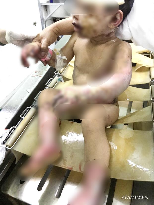 Hai bé trai ở Bình Dương bỏng nặng, hậu quả kéo dài vì bị kẻ xấu dùng bom xăng phóng hỏa đốt nhà-3