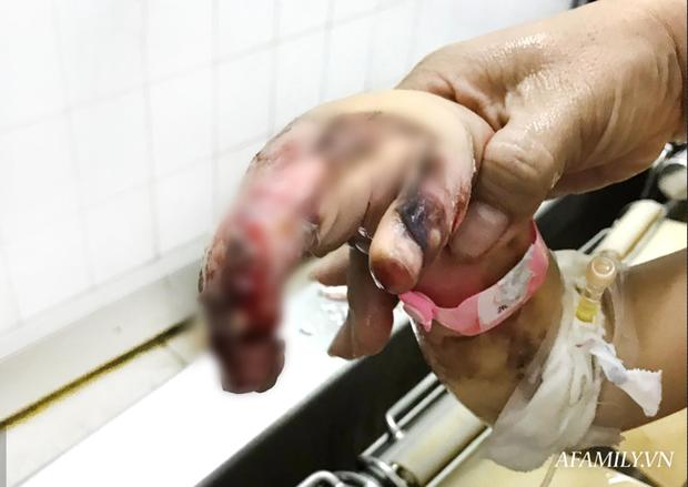 Hai bé trai ở Bình Dương bỏng nặng, hậu quả kéo dài vì bị kẻ xấu dùng bom xăng phóng hỏa đốt nhà-4