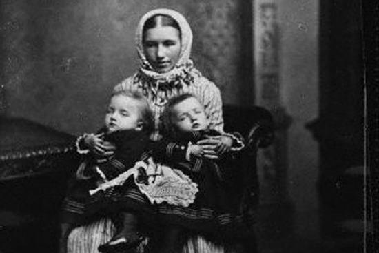 Cặp chị em song sinh dính liền đầu tiên trong lịch sử sinh con, gây thị phi vì quan hệ