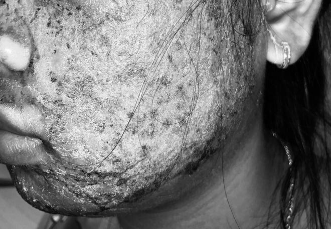 Cô gái 17 tuổi mặt sưng phù, chảy mủ vàng vì dùng sản phẩm thay da sinh học collagen trên mạng-1
