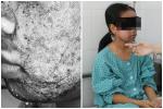 Cô gái 17 tuổi mặt sưng phù, chảy mủ vàng vì dùng sản phẩm 'thay da sinh học collagen' trên mạng