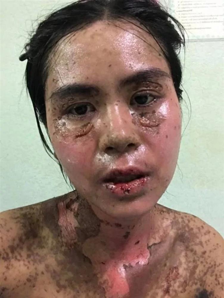 Sốc hình ảnh cô gái như bị thiêu sống sau khi dùng thuốc chữa đau răng-2