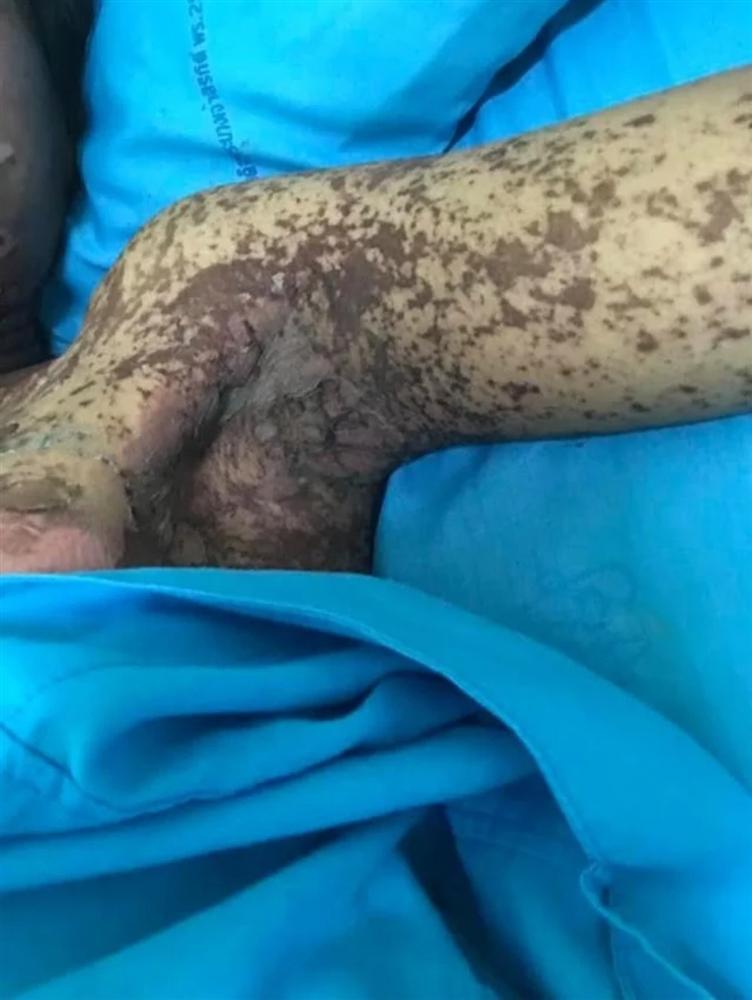 Sốc hình ảnh cô gái như bị thiêu sống sau khi dùng thuốc chữa đau răng-4