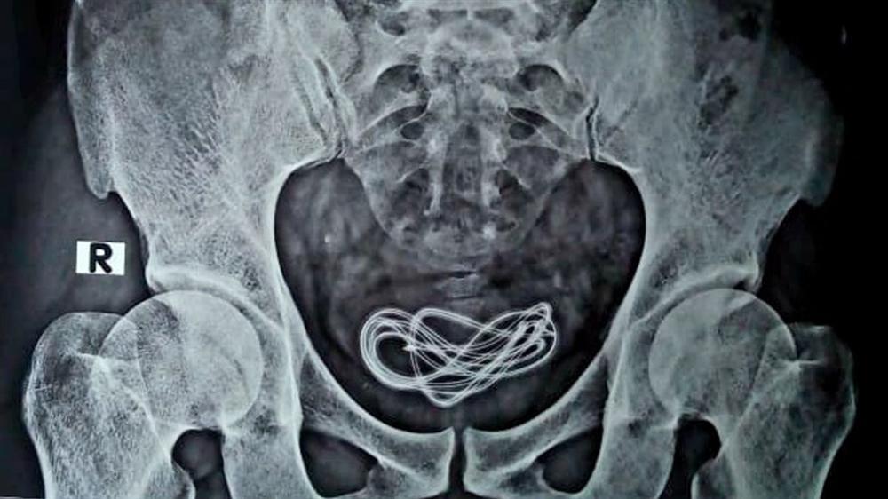 Đút dây sạc điện thoại vào dương vật, người đàn ông đau quặn ruột gan-1