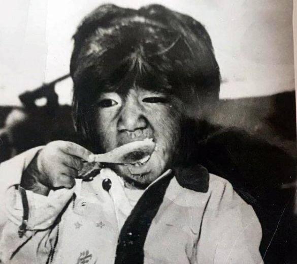 Sinh ra cơ thể phủ toàn lông, cậu bé người vượn từng nổi đình đám giờ sống ra sao?-1