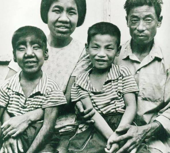 Sinh ra cơ thể phủ toàn lông, cậu bé người vượn từng nổi đình đám giờ sống ra sao?-2