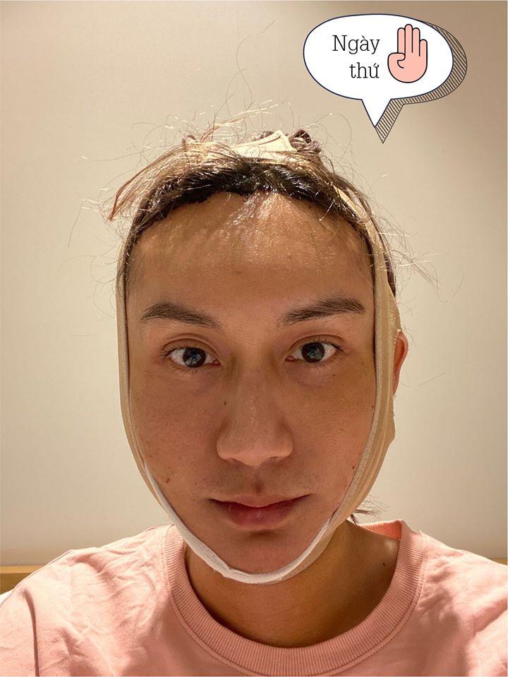 Lynk Lee công khai hình ảnh phẫu thuật thẩm mỹ, nhìn thôi đã đủ rùng mình-7