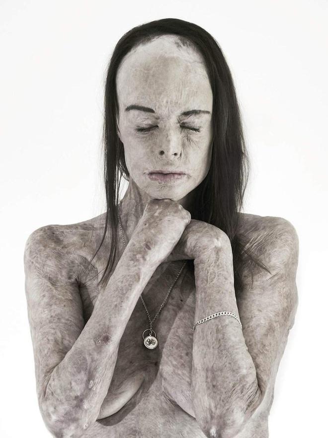 Ảnh khỏa thân của hoa khôi bị bỏng 85% cơ thể-2