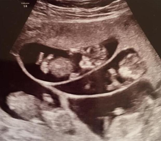 Từng khiến thế giới ngỡ ngàng vì ca sinh 7 cách đây hơn 20 năm, đôi vợ chồng và những đứa trẻ ngày ấy giờ ra sao?-2