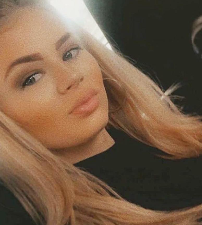 Môi bị sưng phồng, tụ máu vì tiêm filler kém chất lượng-1