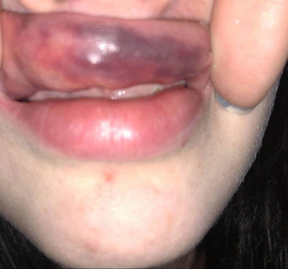 Môi bị sưng phồng, tụ máu vì tiêm filler kém chất lượng-3