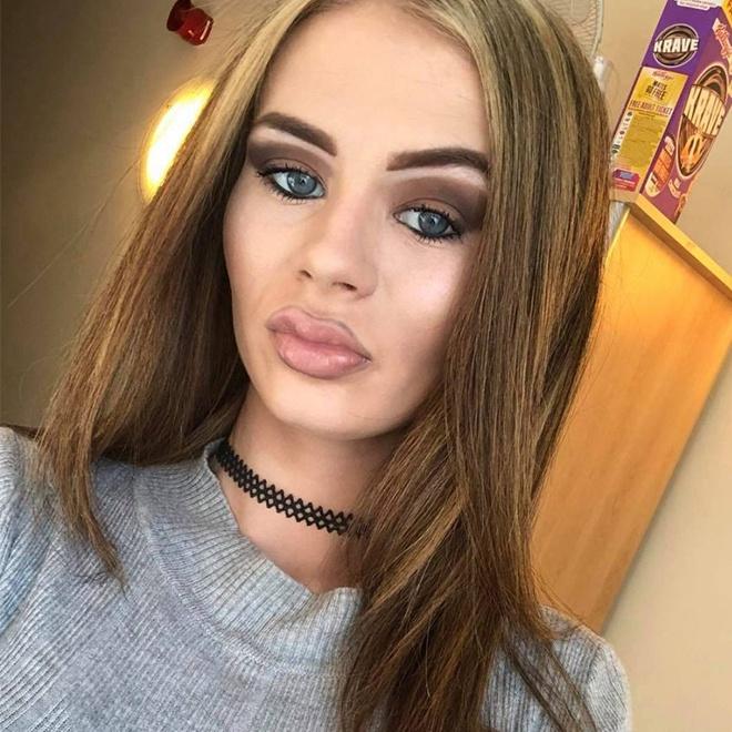 Môi bị sưng phồng, tụ máu vì tiêm filler kém chất lượng-4