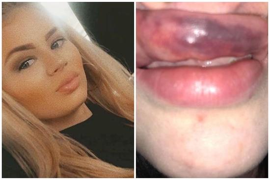 Môi bị sưng phồng, tụ máu vì tiêm filler kém chất lượng