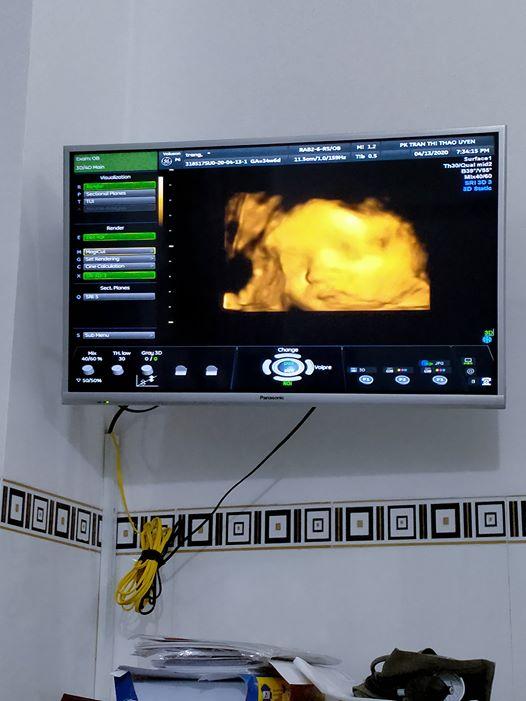 Con gái 1 tháng tuổi của người đàn ông đầu tiên sinh con ở Việt Nam càng lớn càng yêu-4