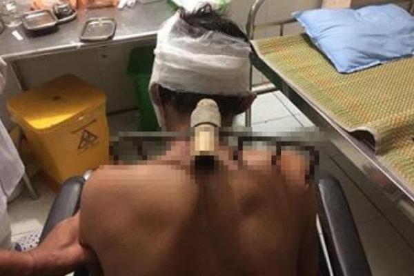 Con trai bổ cào vào vai bố đẻ chỉ vì chưa nấu cơm ở Thái Nguyên-1