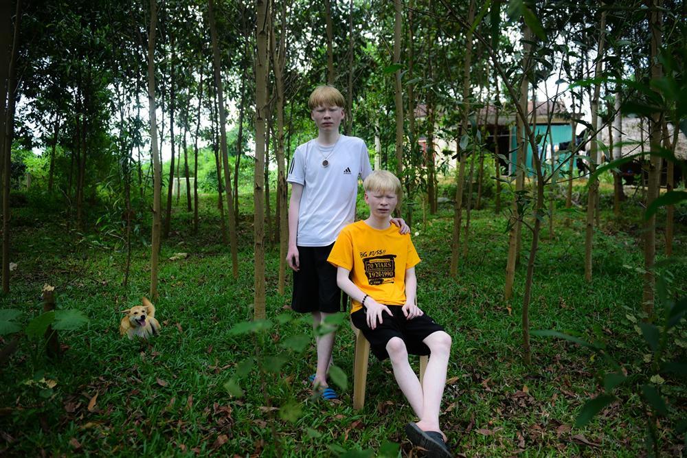 Thế giới riêng của cặp song sinh bạch tạng hiếm có ở Hà Tĩnh-1