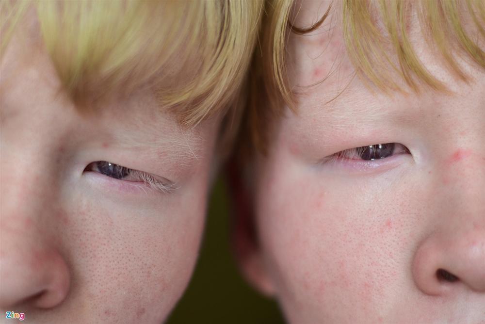 Thế giới riêng của cặp song sinh bạch tạng hiếm có ở Hà Tĩnh-3