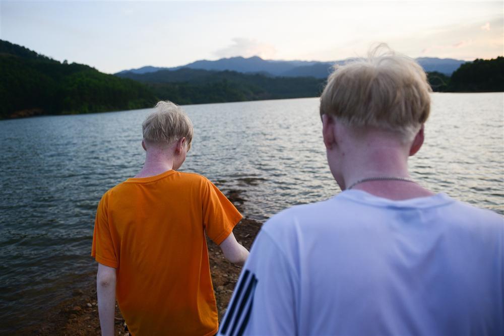 Thế giới riêng của cặp song sinh bạch tạng hiếm có ở Hà Tĩnh-14