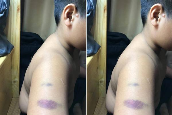 Phụ huynh tố cô giáo trường Quốc tế Á Châu đánh học sinh bầm tím tay-1