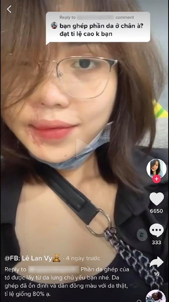 Gương mặt cô gái Đà Nẵng bị chồng sắp cưới tạt axit đến biến dạng hồi phục thần kì-2