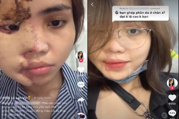 Cô gái bị chồng sắp cưới tạt axit lần đầu lộ diện cả khuôn mặt, tiết lộ 16 lần phẫu thuật đau đớn-4