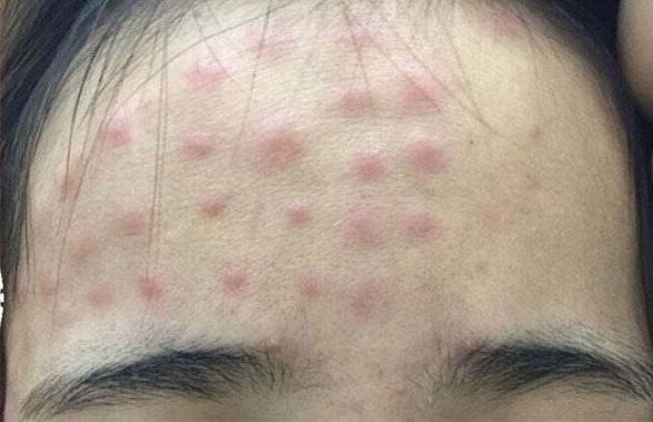 Hàng loạt trường hợp da nổi sần đỏ thành hàng vì tiêm tế bào gốc để trẻ hóa làn da-2