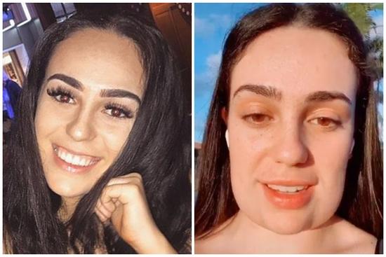 Gương mặt 10X thành hình vuông vì đi hút mỡ cằm