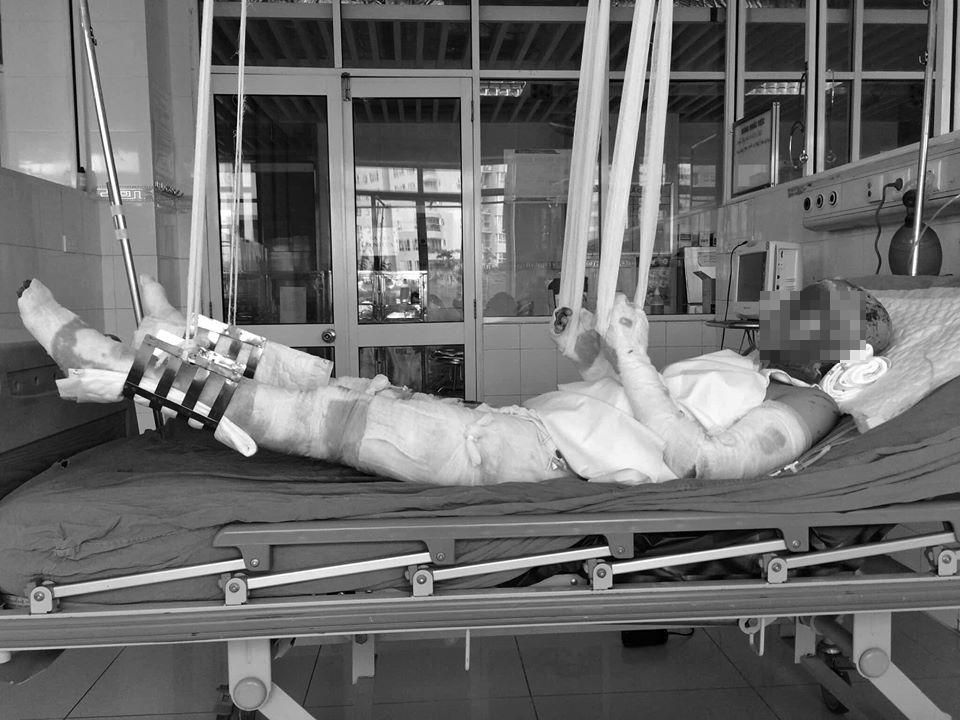 Nghị lực sống phi thường của cô giáo trẻ từng tai nạn bỏng nặng toàn thân-3