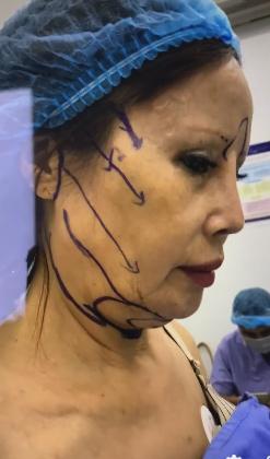 Cô dâu 63 tuổi thẩm mỹ căng da mặt, thành quả phẫu thuật ai cũng rùng mình-2