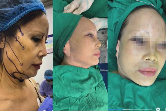 Cô dâu 63 tuổi thẩm mỹ căng da mặt, thành quả phẫu thuật ai cũng rùng mình