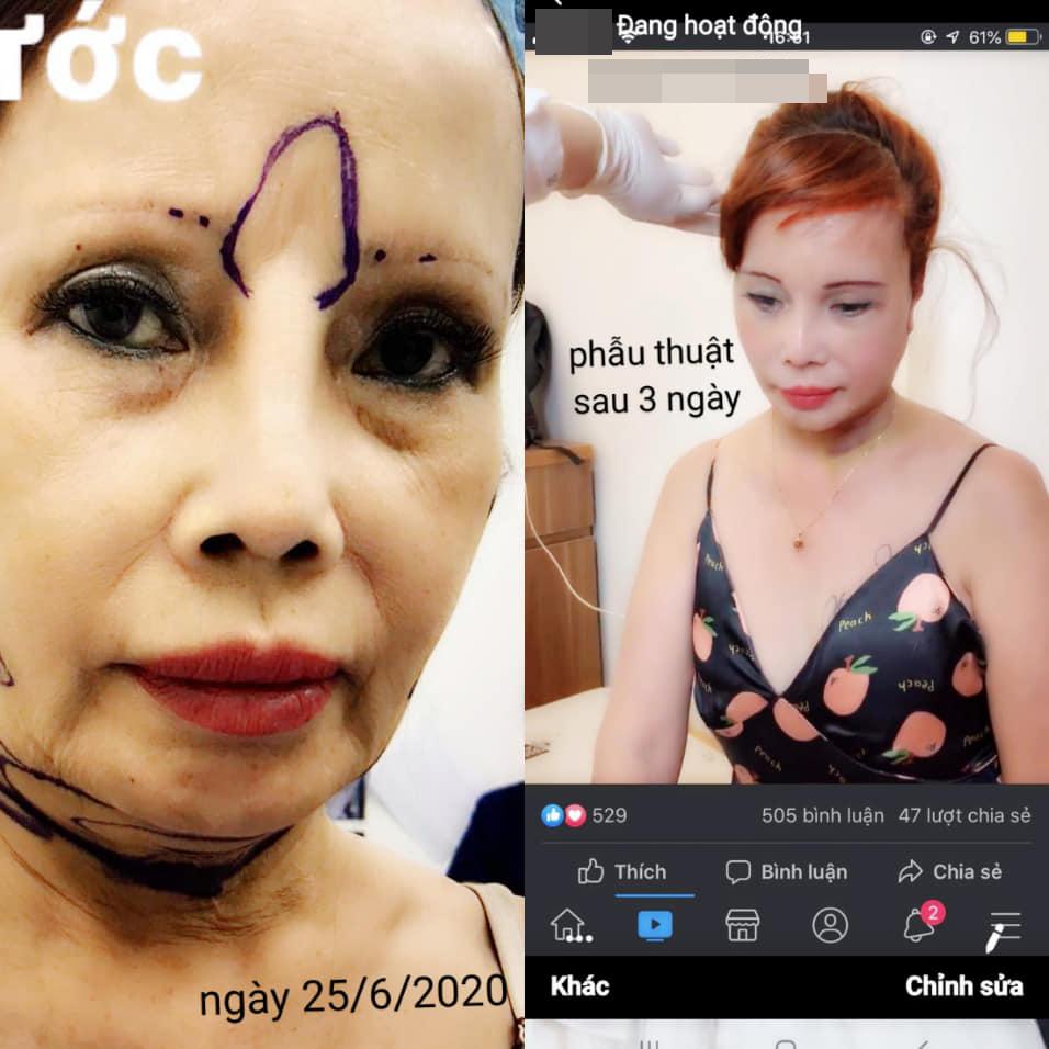 Sau 3 ngày phẫu thuật, cô dâu Cao Bằng khoe làn da căng bóng như thiếu nữ-5