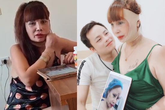 Miệng méo lệch mặt sau 4 ngày 'dao kéo', cô dâu Cao Bằng lo lắng biến chứng