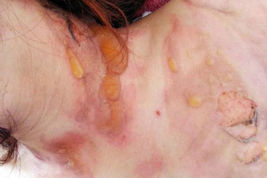 Tự gây thương tích rồi dựng chuyện bị đốt, cướp 500 triệu đồng