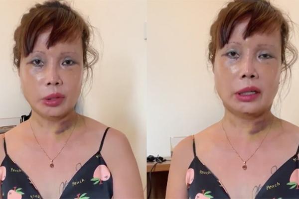 Mặt cô dâu 63 tuổi ở Cao Bằng đỏ rực, sưng phù, biến dạng gây ám ảnh-8