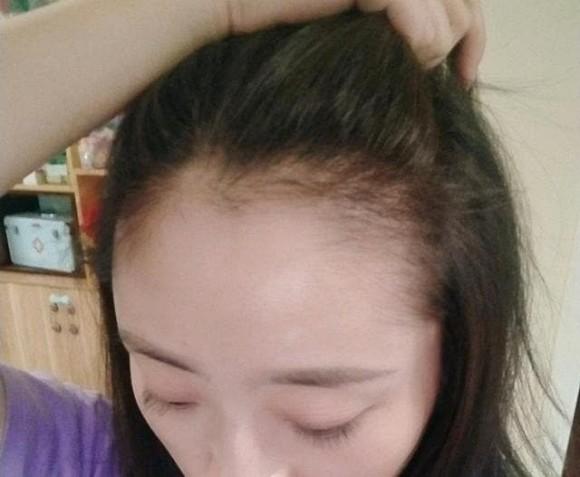 5 thói quen xấu khiến ngôi tóc to và đường chân tóc mọc về phía sau như hói, thậm chí rụng tóc liên tục-2