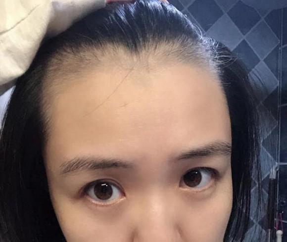 5 thói quen xấu khiến ngôi tóc to và đường chân tóc mọc về phía sau như hói, thậm chí rụng tóc liên tục-5