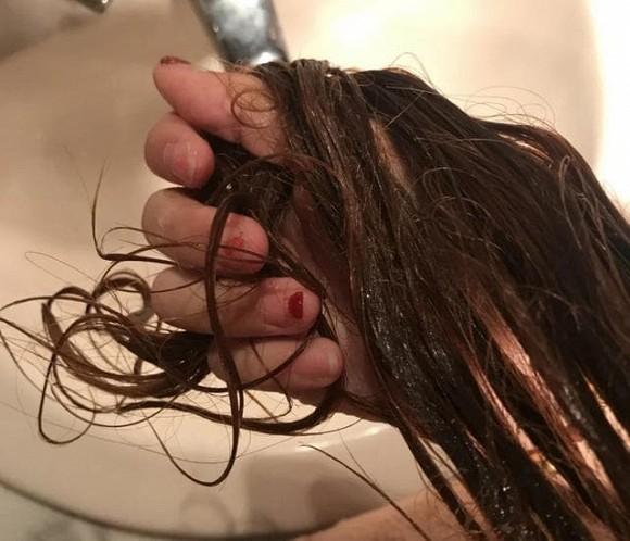 5 thói quen xấu khiến ngôi tóc to và đường chân tóc mọc về phía sau như hói, thậm chí rụng tóc liên tục-6