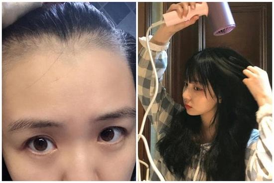 5 thói quen xấu khiến ngôi tóc to và đường chân tóc mọc về phía sau như hói, thậm chí rụng tóc liên tục