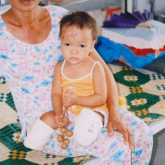 Bé gái người Quảng Nam mất 2 chân trong vụ nổ thương tâm 17 năm trước giờ ra sao?-1