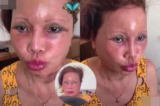 Mặt cô dâu 63 tuổi ở Cao Bằng đỏ rực, sưng phù, biến dạng gây ám ảnh