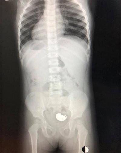 Gia đình hốt hoảng phát hiện bé gái 3 tuổi nuốt chiếc vòng trang sức của mẹ vào bụng-1