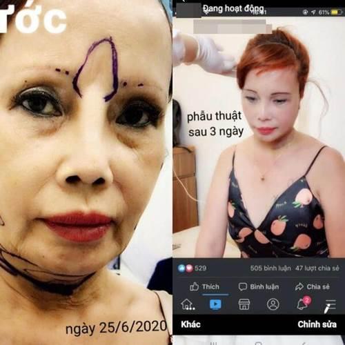 Mới căng da mặt, cô dâu Cao Bằng lại muốn trùng tu vòng 1: Có quá vội vàng?-2