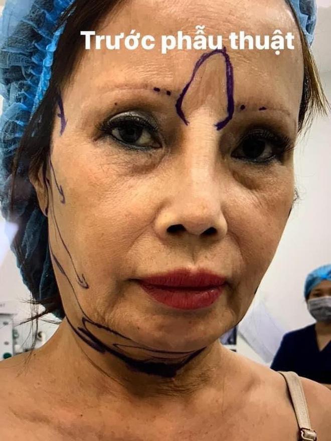 Ảnh mới của cô dâu 63 tuổi sau gần 2 tuần dao kéo: Mặt bớt sưng nhưng mồm vẫn méo-1
