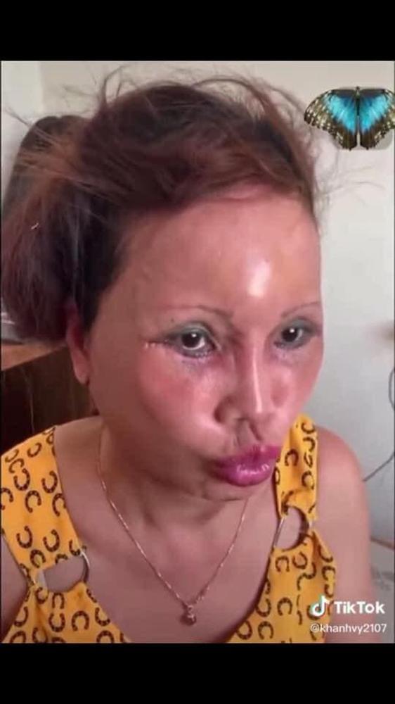 Ảnh mới của cô dâu 63 tuổi sau gần 2 tuần dao kéo: Mặt bớt sưng nhưng mồm vẫn méo-3