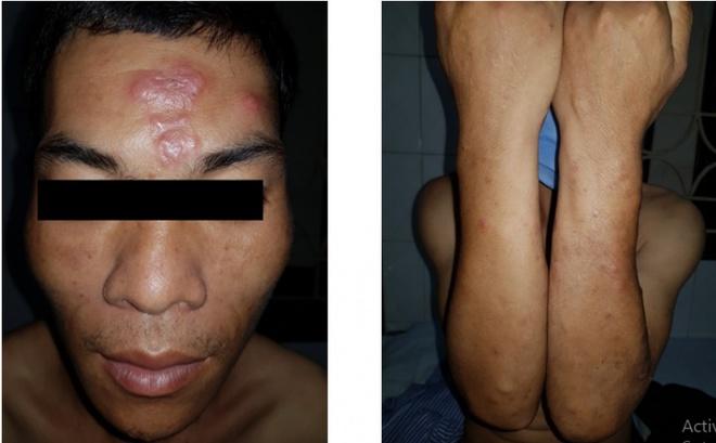 Bệnh phong xuất hiện ở Lạng Sơn-1