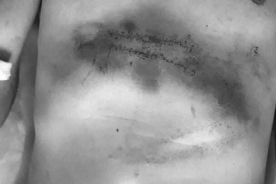 Mời chủ nợ vào nhà uống rượu rồi trói lại, đánh đến nguy kịch