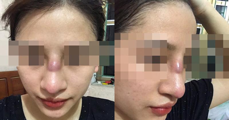 Biến chứng hậu phẫu thuật nâng mũi, cô gái bị áp xe đến lòi cả sụn-1