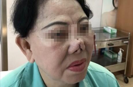 Biến chứng hậu phẫu thuật nâng mũi, cô gái bị áp xe đến lòi cả sụn-8