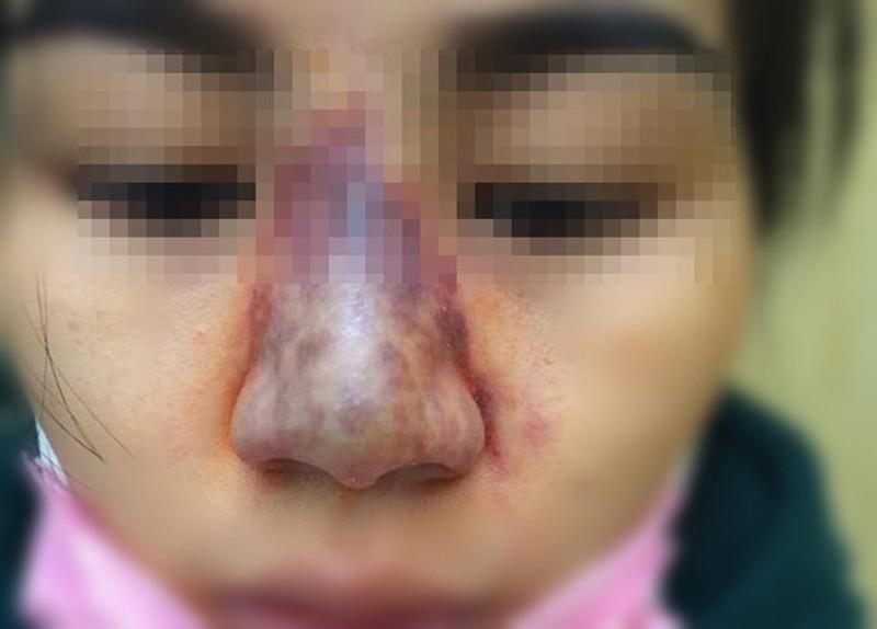 Biến chứng hậu phẫu thuật nâng mũi, cô gái bị áp xe đến lòi cả sụn-6